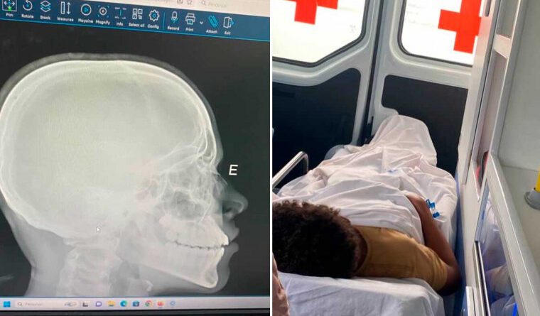 Denúncia de racismo e agressão que fraturou nariz de aluno em escola vira alvo do MPTO