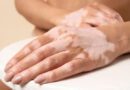 Manchas na pele, preconceito e o impacto emocional da desinformação: entenda o vitiligo