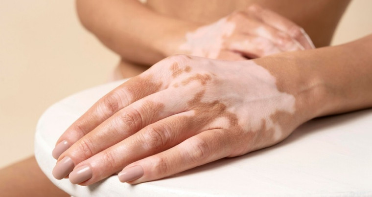 Manchas na pele, preconceito e o impacto emocional da desinformação: entenda o vitiligo