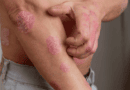 Psoríase atinge 3 milhões de brasileiros, mas ainda é pouco compreendida, diz dermatologista
