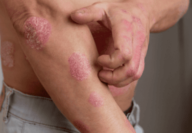 Psoríase atinge 3 milhões de brasileiros, mas ainda é pouco compreendida, diz dermatologista