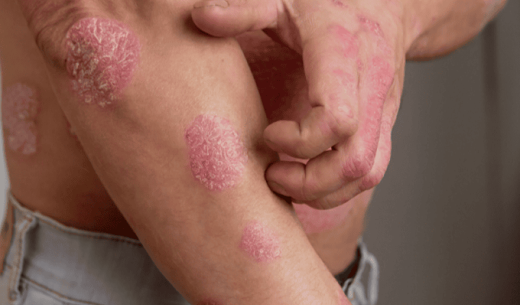 Psoríase atinge 3 milhões de brasileiros, mas ainda é pouco compreendida, diz dermatologista